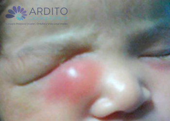 Amniocele. Dacriocistitis aguda - Oculoplastica Ardito