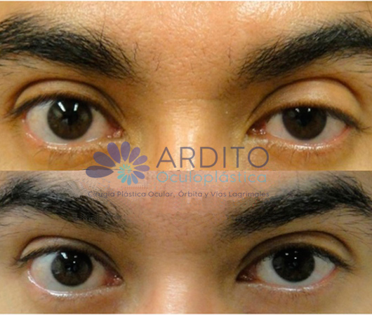 Corrección de ptosis ojo izquierdo - Oculoplastica Ardito