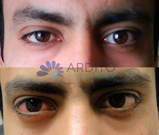 Corrección de ptosis y blefaroplastia transconjuntival ojo derecho - Oculoplastica Ardito