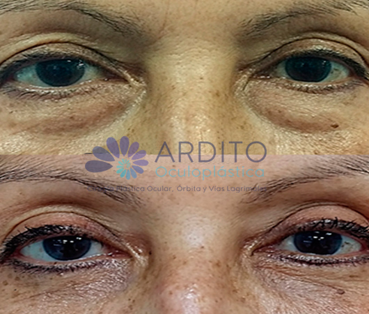 Blefaroplastia Inferior Transconjuntival - Oculoplastica Ardito