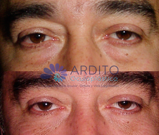 Blefaroplastia transconjuntival - Oculoplastica Ardito