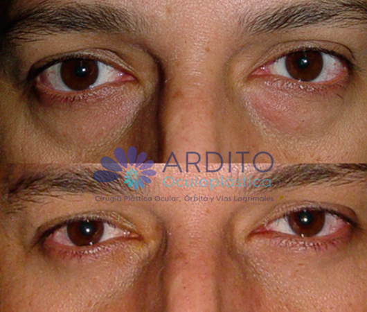 Blefaroplastia transconjuntival - Oculoplastica Ardito