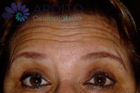 Tratamiento de arrugas frontales - Oculoplastica Ardito