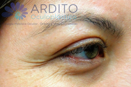 Tratamiento de líneas de los ojos y elevación de la ceja - Oculoplastica Ardito