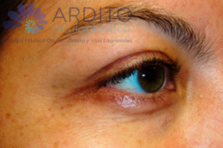 Tratamiento de líneas de los ojos y elevación de la ceja - Oculoplastica Ardito