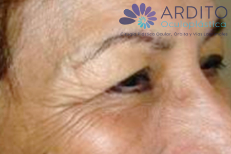 Elevación de cejas con toxina botulínica - Oculoplastica Ardito