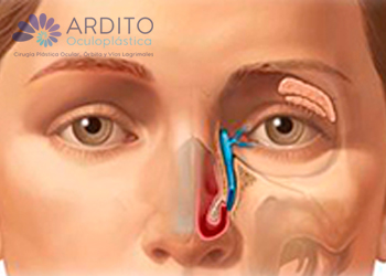 Vía lagrimal - Oculoplastica Ardito