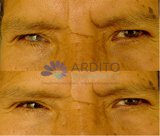 Lente de contacto blando cosmético - Oculoplastica Ardito