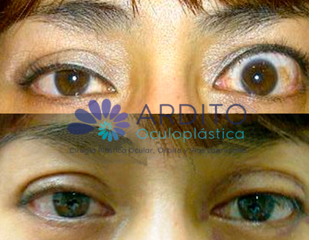 Corrección de retracción del párpado superior ojo izquierdo - Oculoplastica Ardito