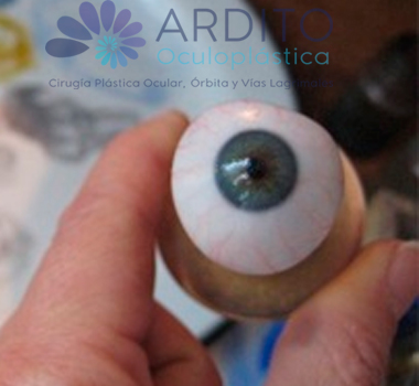 Elaboración de prótesis oculares - Oculoplastica Ardito