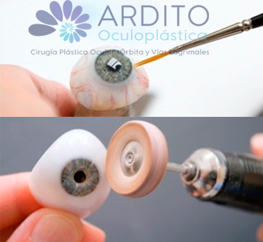 Elaboración de prótesis oculares - Oculoplastica Ardito