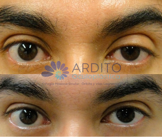 Corrección de ptosis ojo izquierdo- Oculoplastica Ardito