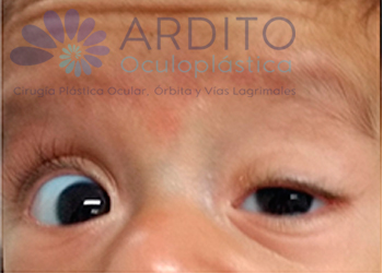 Corrección de ptosis congénita del ojo izquierdo - Oculoplastica Ardito