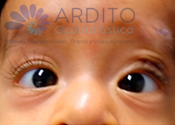 Corrección de ptosis congénita del ojo izquierdo - Oculoplastica Ardito