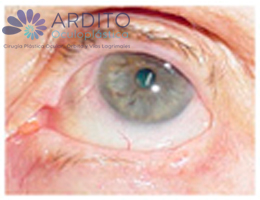 tumor de párpado - Oculoplastica Ardito