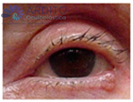 tumor de párpado - Oculoplastica Ardito