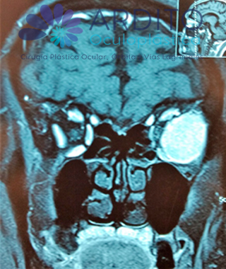 Metástasis orbitaria de tumor abdominal - Oculoplastica Ardito